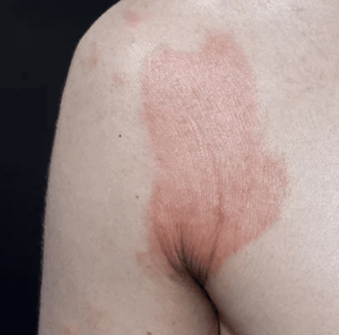 Eczema Treatment & Care